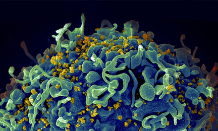 HIV, the AIDS virus, infecting a human cell